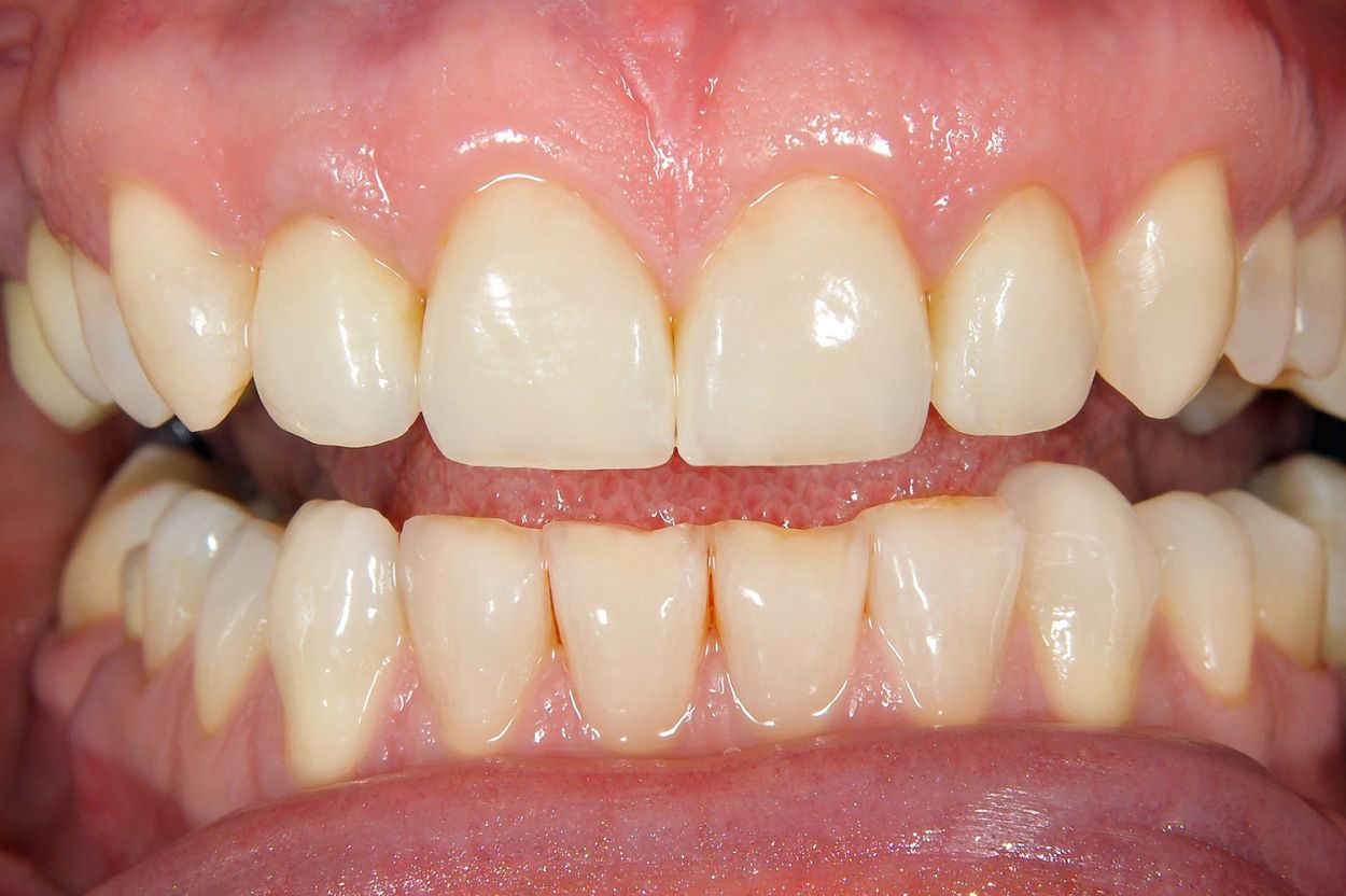 composite bonding