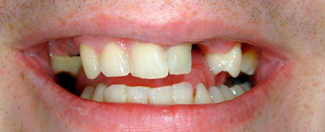 Implant Denture Before