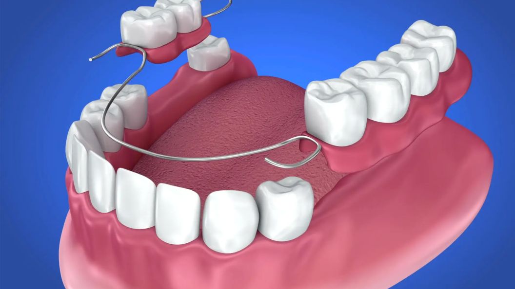 Partial Dentures Video