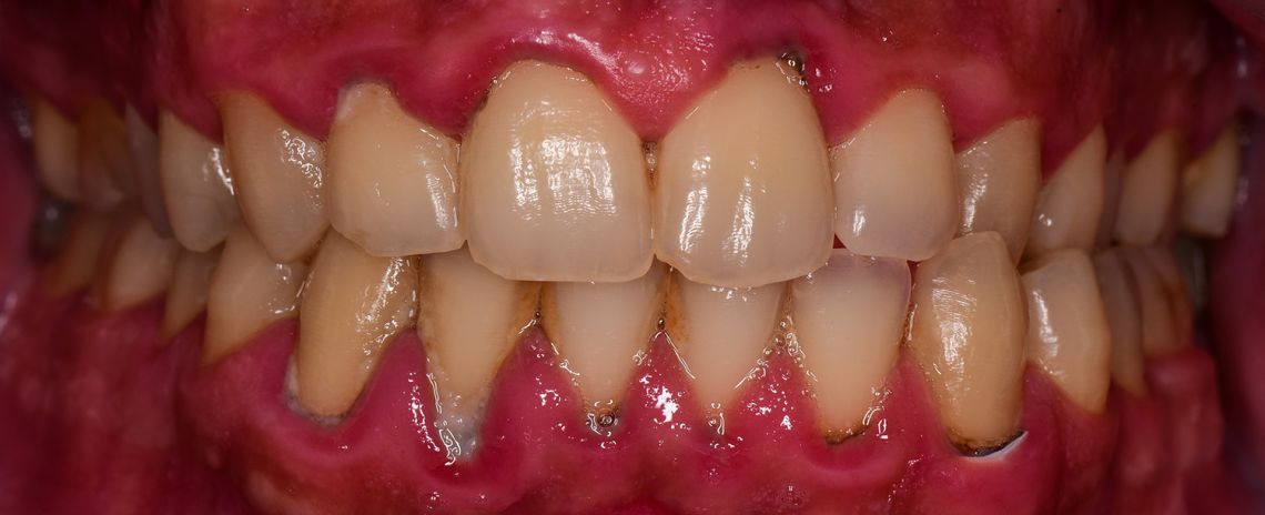 Gum Disease Clean Before