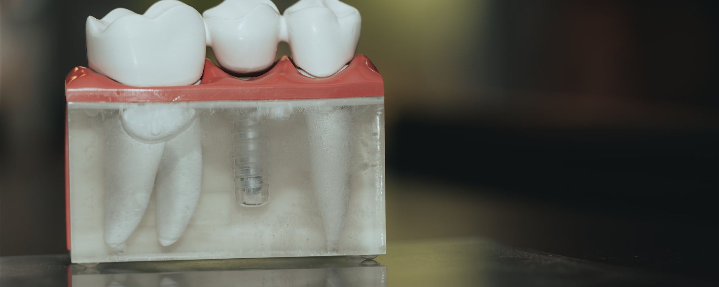 Single tooth dental implants
