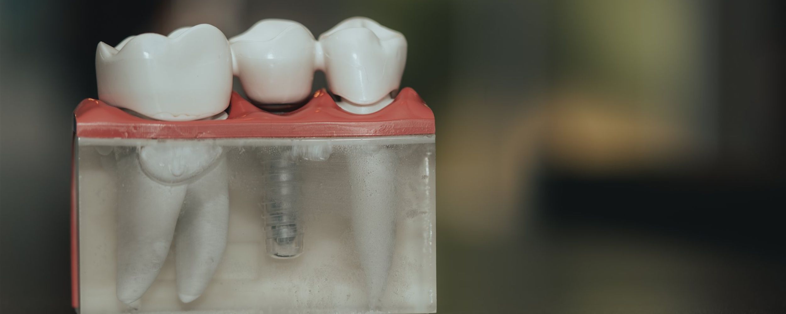 Dental implants