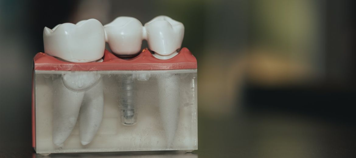 Implants