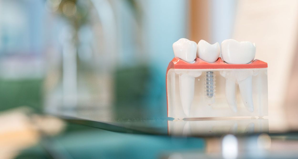 Dental implants image