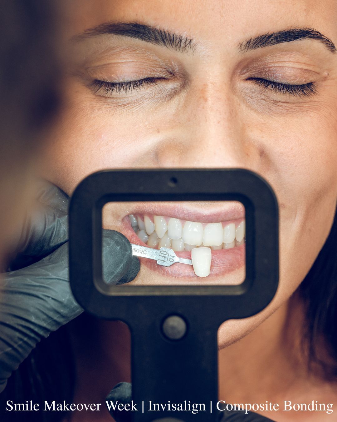 Smile Makeover Event – Invisalign® & Composite Bonding Save up to £600!