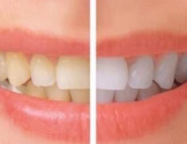 Whitening