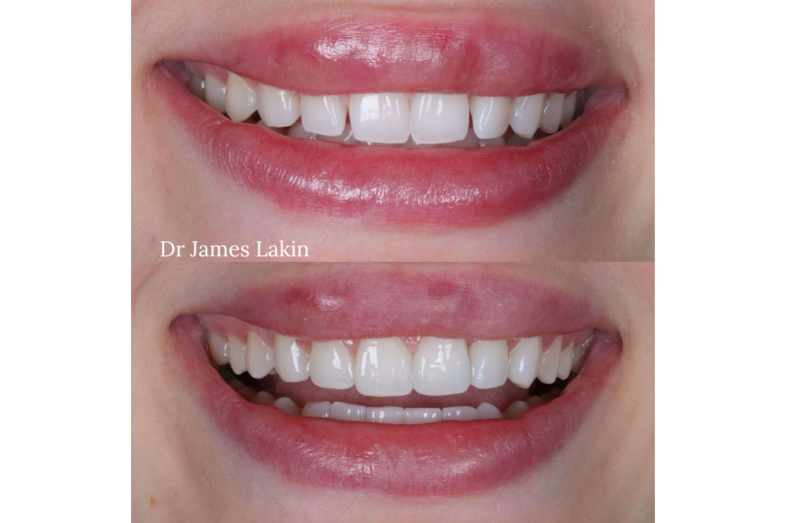 smilemakeover2