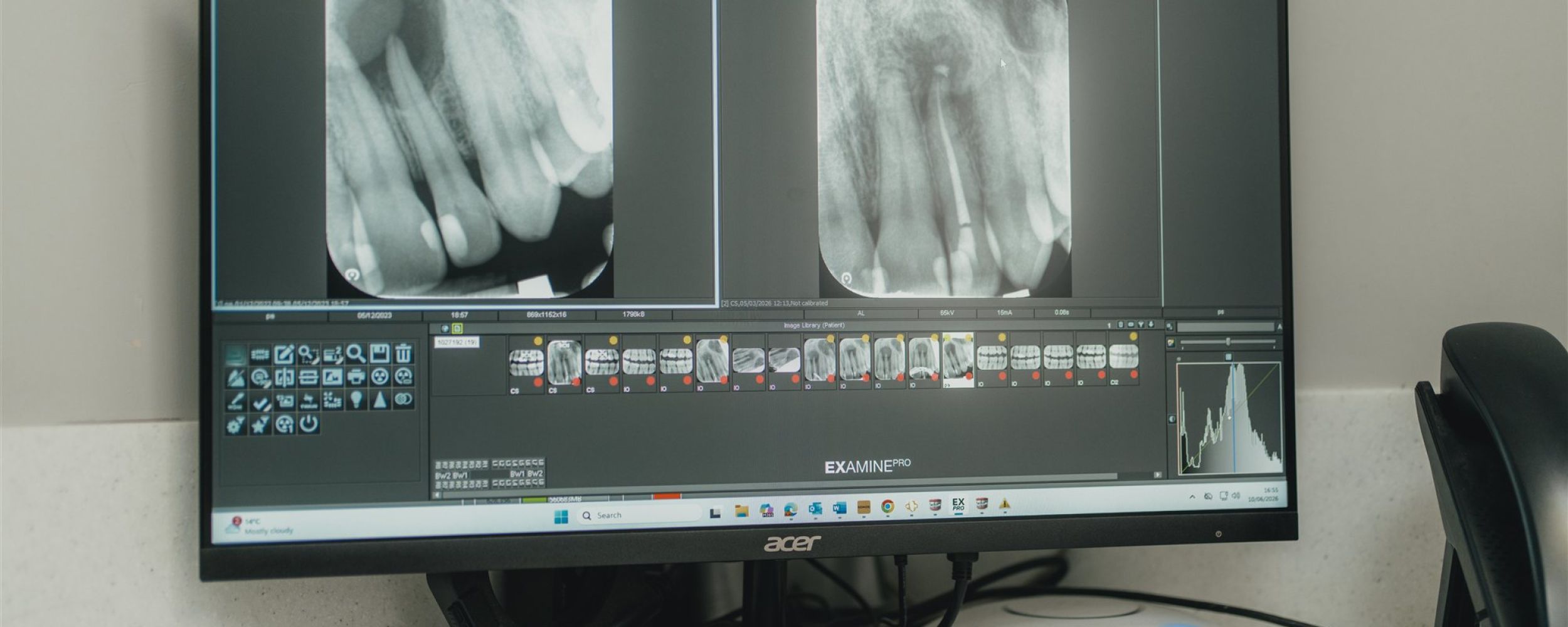 Root canal